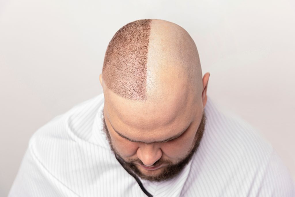 best hair transplant in turkey